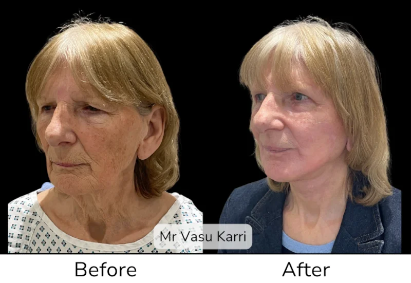 Facelift Patient 9 View 3